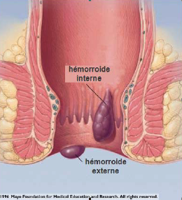 Hémorroïdes : interne, externe, photo, causes